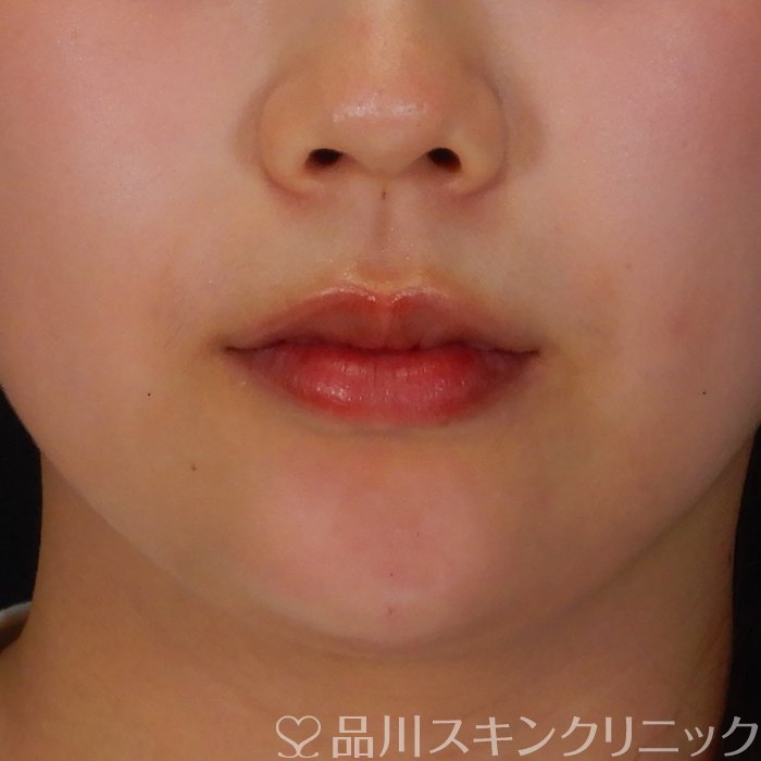 症例NO.69764のAFTER写真