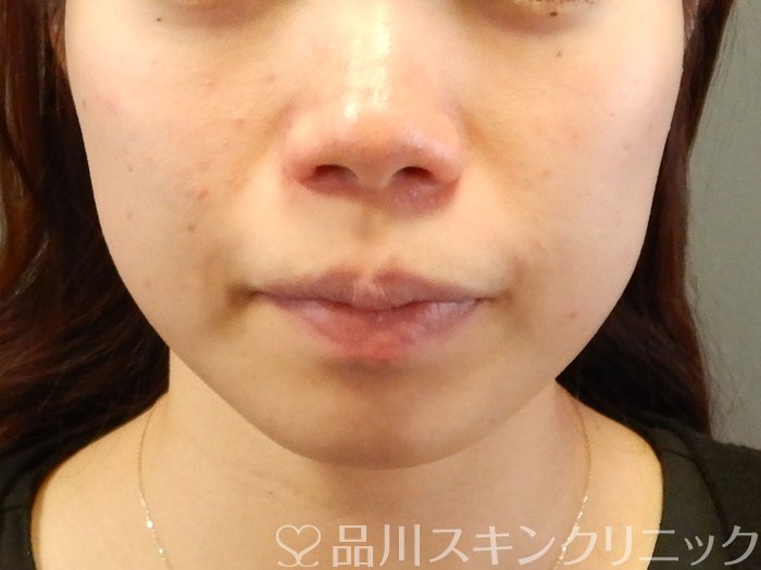症例NO.63594のBEFORE写真