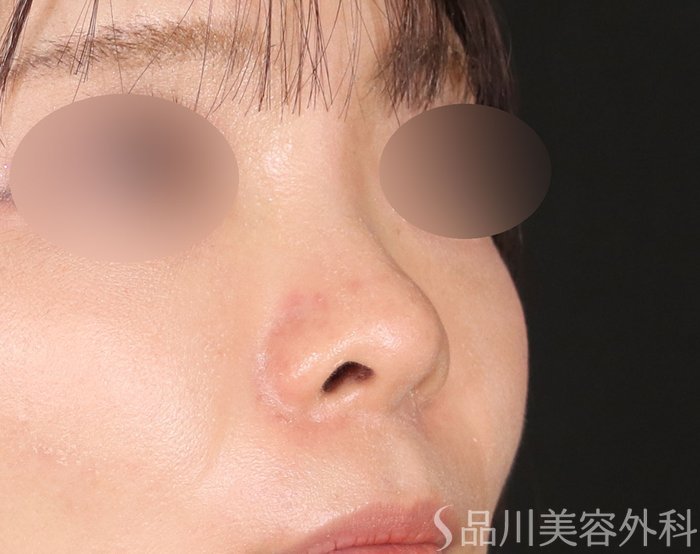 症例NO.72323のBEFORE写真