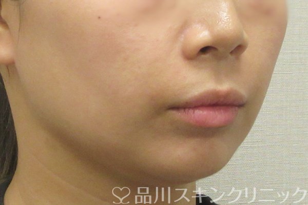 症例NO.74505のAFTER写真