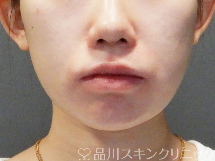 症例NO.73277のBEFORE写真