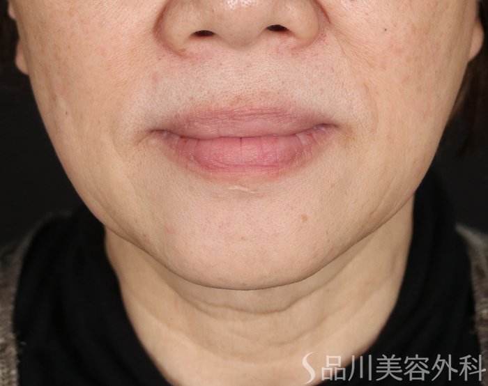 症例NO.72474のBEFORE写真