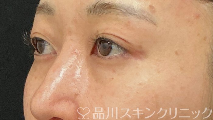 症例NO.74381のBEFORE写真