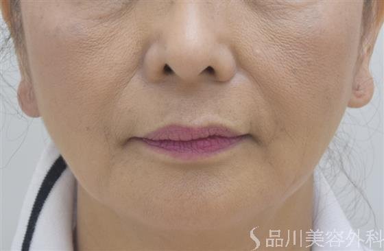 症例NO.44402のAFTER写真