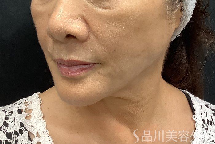 症例NO.69839のAFTER写真