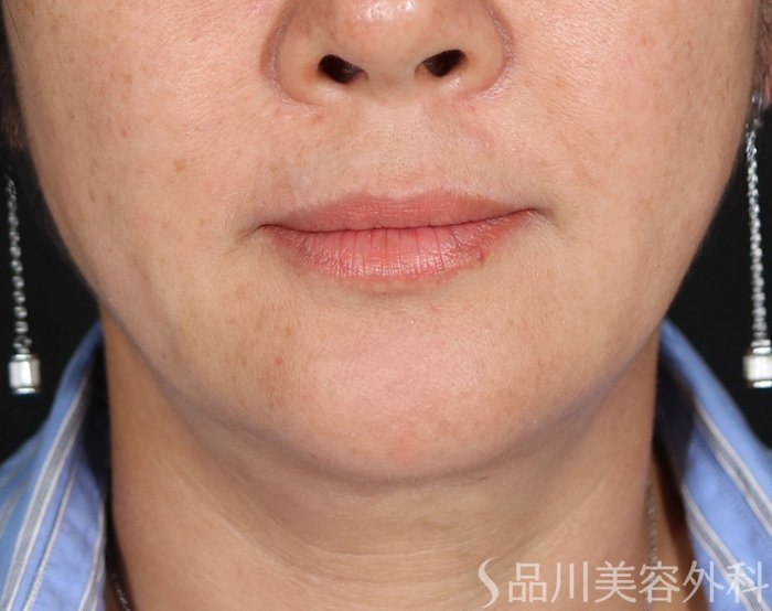 症例NO.71517のBEFORE写真