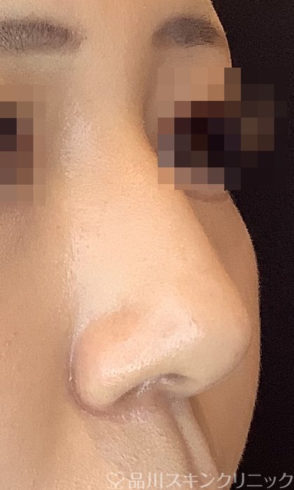 症例NO.69865のAFTER写真