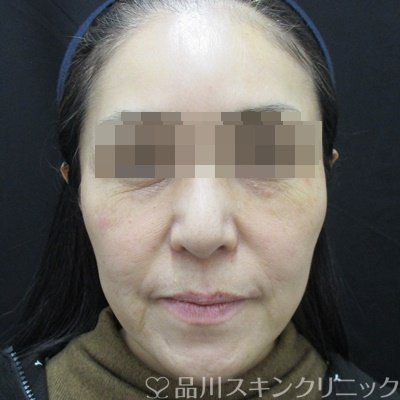 症例NO.64822のBEFORE写真