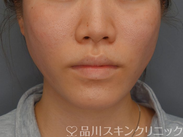 症例NO.74136のAFTER写真
