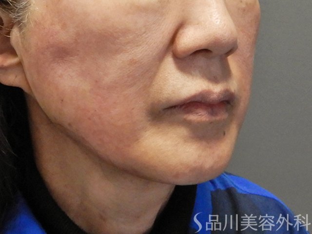 症例NO.73096のAFTER写真