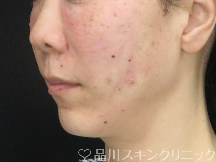 症例NO.69754のAFTER写真