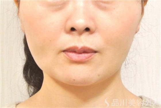 症例NO.15646のAFTER写真