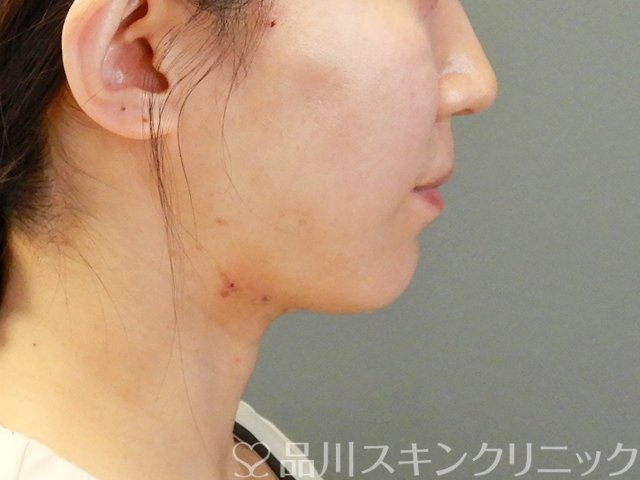 症例NO.63831のAFTER写真