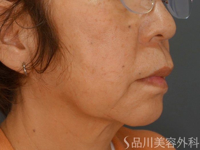 症例NO.74636のBEFORE写真