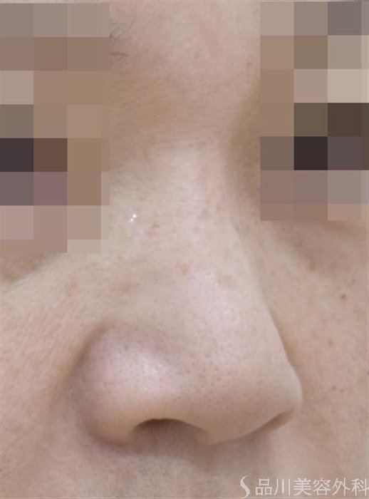 症例NO.48540のBEFORE写真