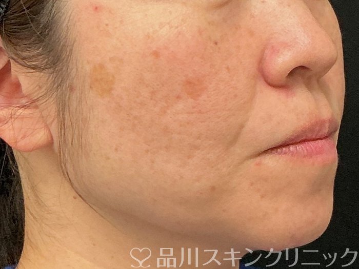 症例NO.74277のBEFORE写真