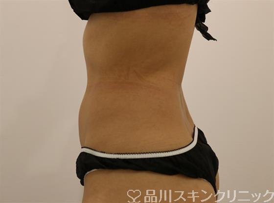 症例NO.44448のAFTER写真