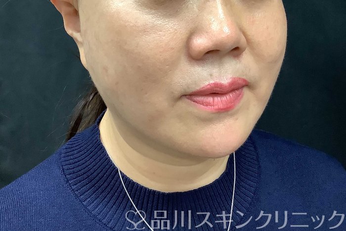 症例NO.71283のAFTER写真