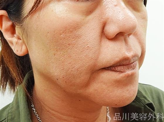 症例NO.33694のBEFORE写真