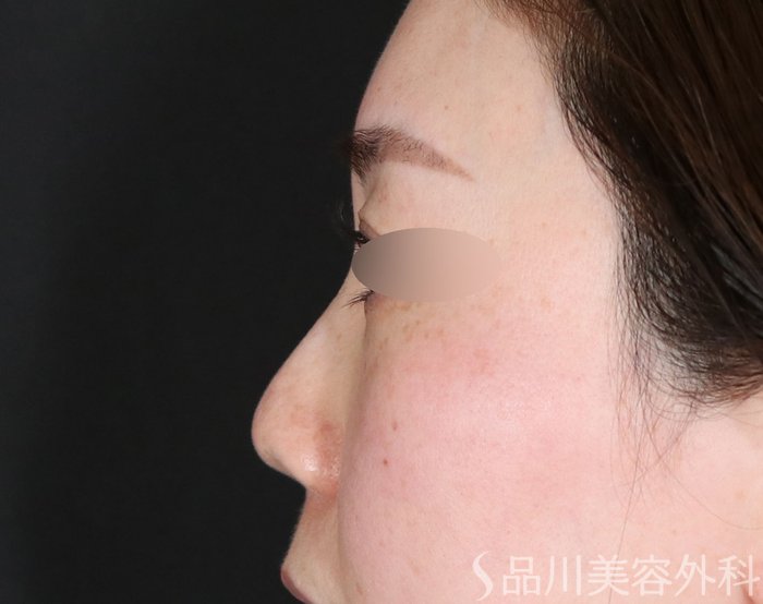 症例NO.72636のBEFORE写真