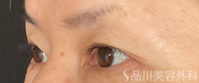 症例NO.75024のBEFORE写真