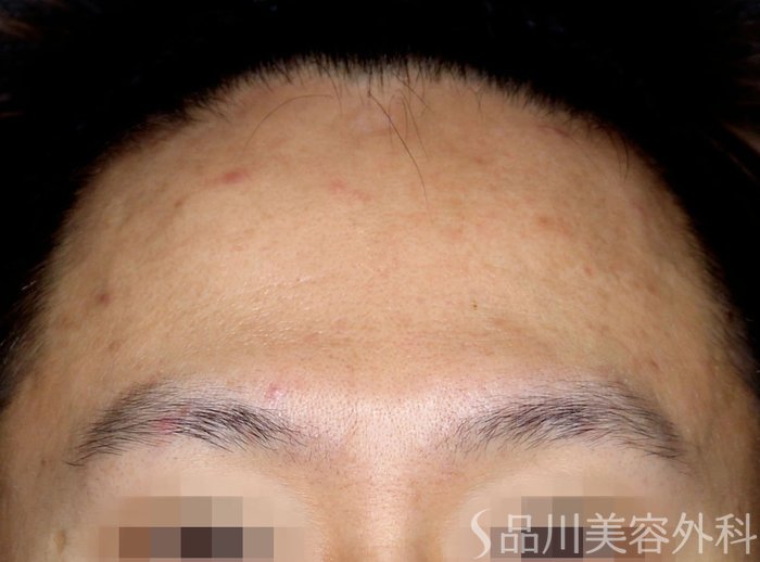症例NO.67404のBEFORE写真