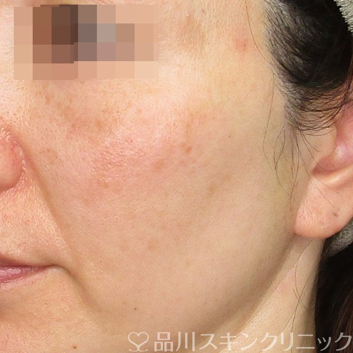 症例NO.74983のBEFORE写真