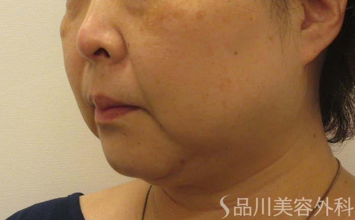 症例NO.71895のBEFORE写真