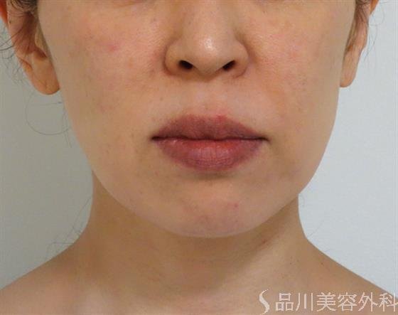 症例NO.42297のBEFORE写真