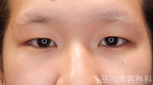 症例NO.75314のBEFORE写真