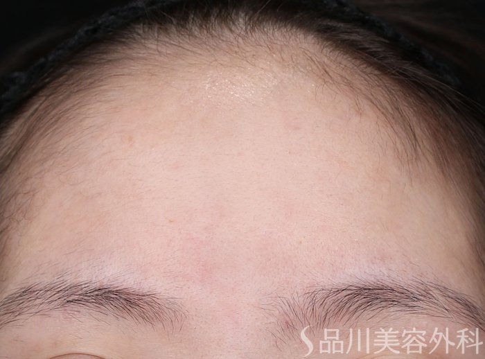 症例NO.72157のAFTER写真