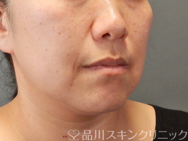 症例NO.75062のBEFORE写真