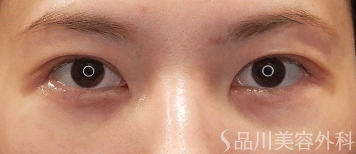 症例NO.71728のAFTER写真