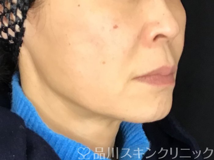 症例NO.69593のBEFORE写真