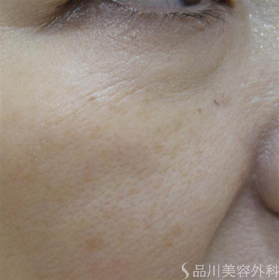 症例NO.45649のAFTER写真