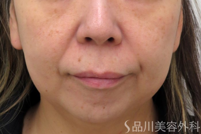 症例NO.74160のBEFORE写真