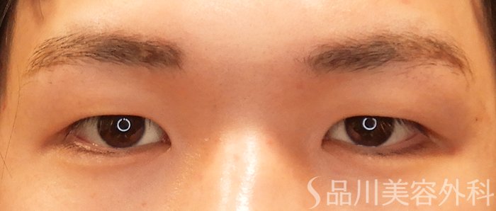 症例NO.70500のBEFORE写真