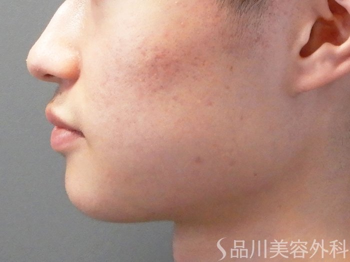 症例NO.70962のAFTER写真