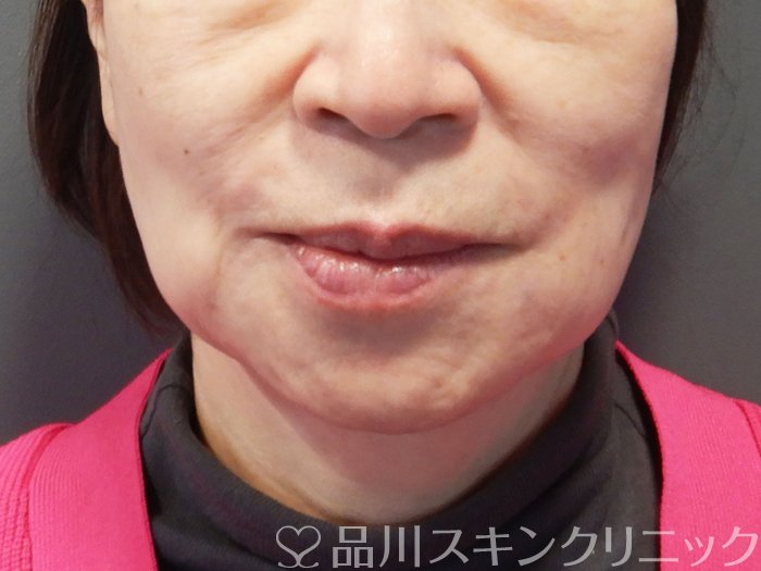 症例NO.73439のAFTER写真