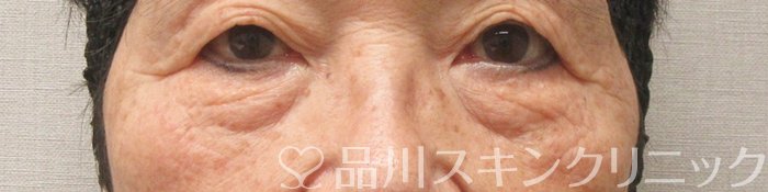 症例NO.75343のBEFORE写真