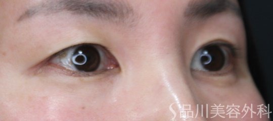 症例NO.70156のBEFORE写真