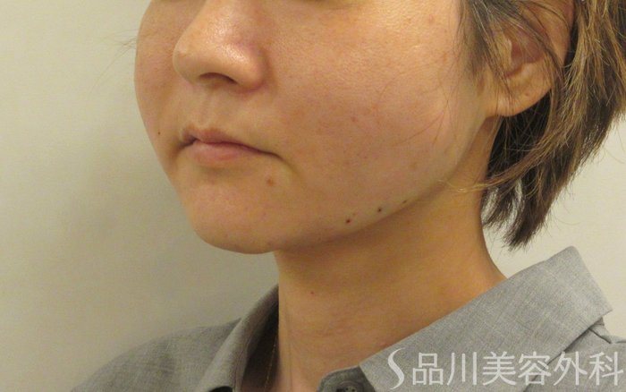 症例NO.70577のAFTER写真