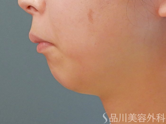 症例NO.69730のBEFORE写真