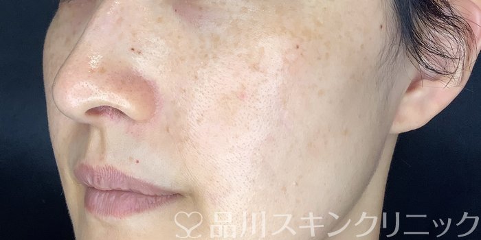 症例NO.70747のAFTER写真