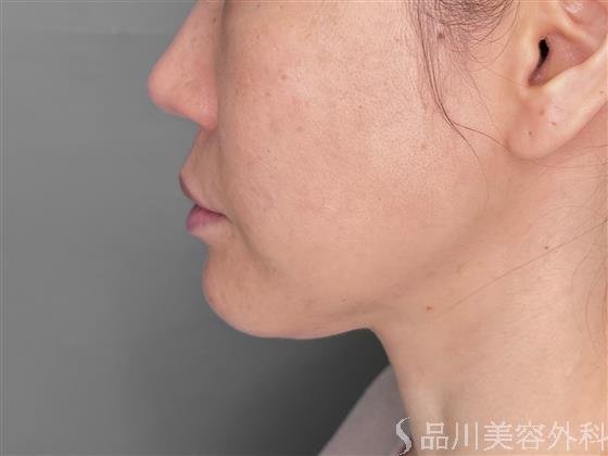 症例NO.53951のBEFORE写真