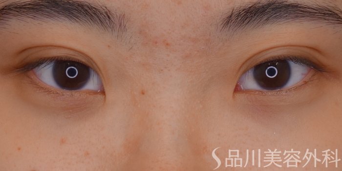 症例NO.65683のAFTER写真
