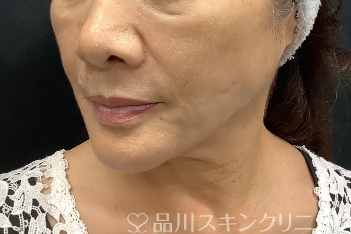 症例NO.69839のAFTER写真