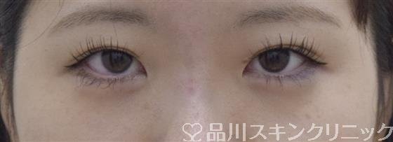 症例NO.54326のAFTER写真