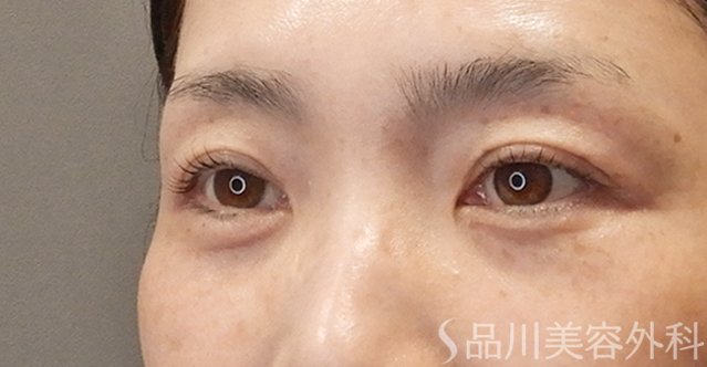 症例NO.74745のAFTER写真