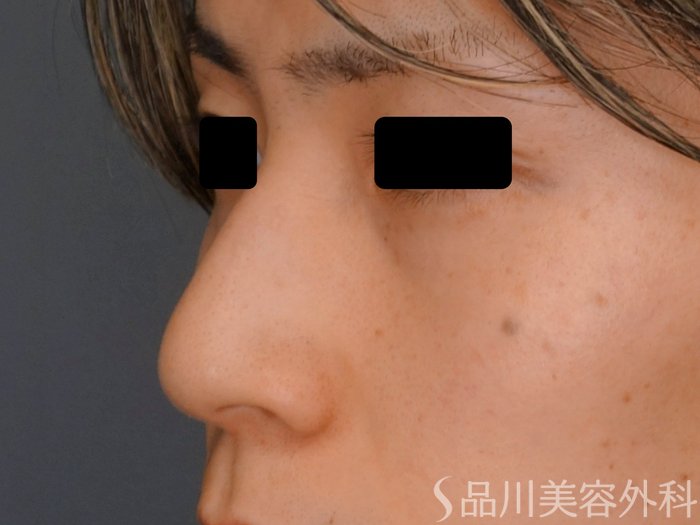 症例NO.74697のBEFORE写真